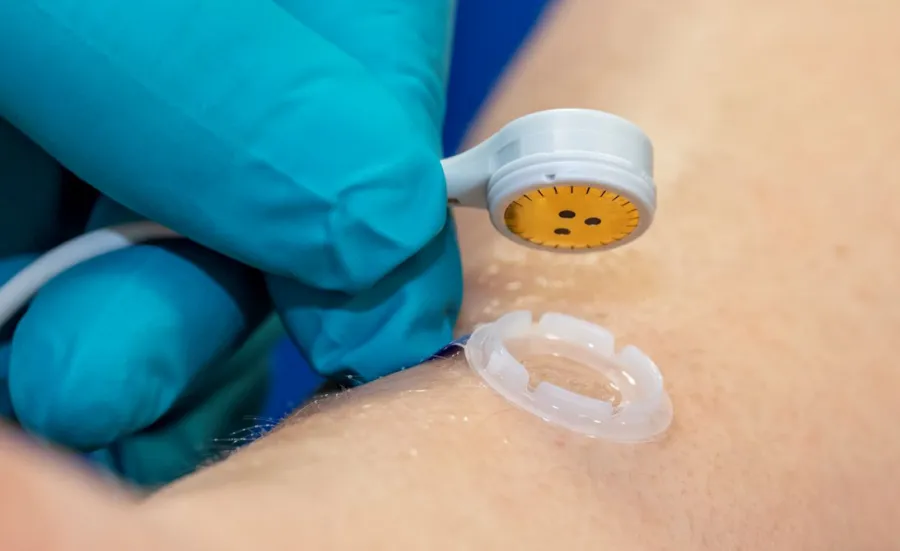 Close up of a skin sensor being placed on a patient's arm