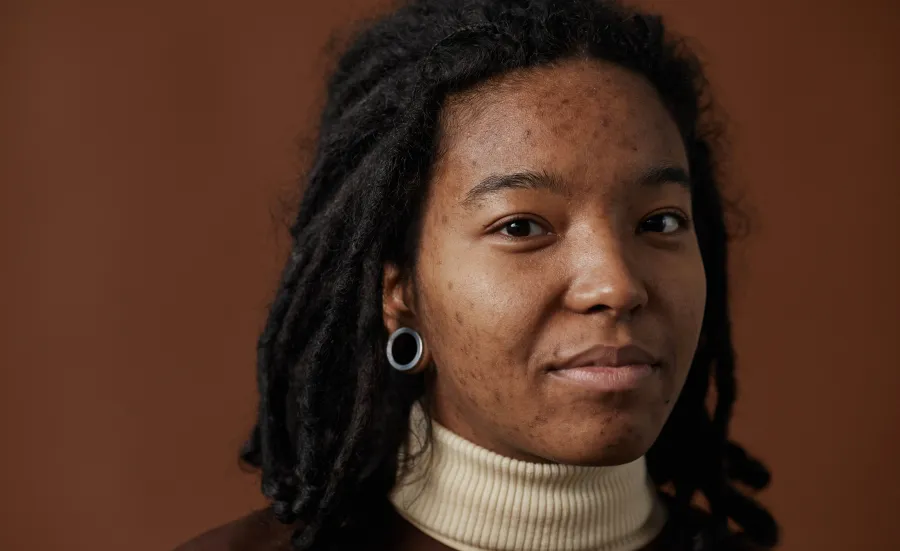 A close-up of a young black woman with acne, wearing a beige turtleneck shirt and looking directly at the camera.