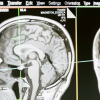 MRI scan of a human head showing the brain in profile